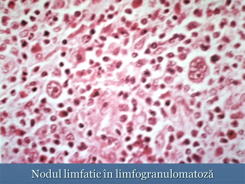 Nodul limfatic în limfogranulomatoză